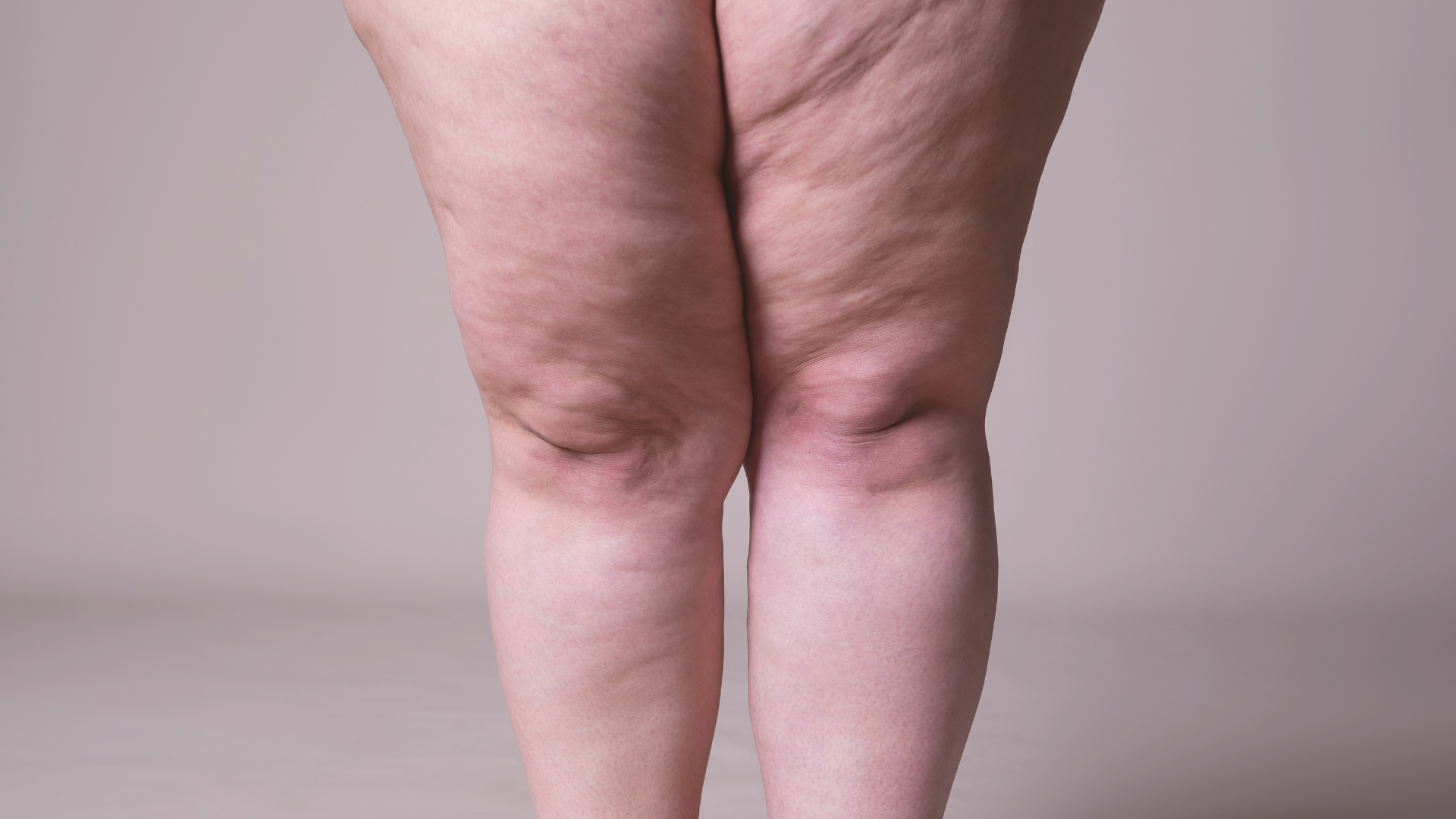 lipedema