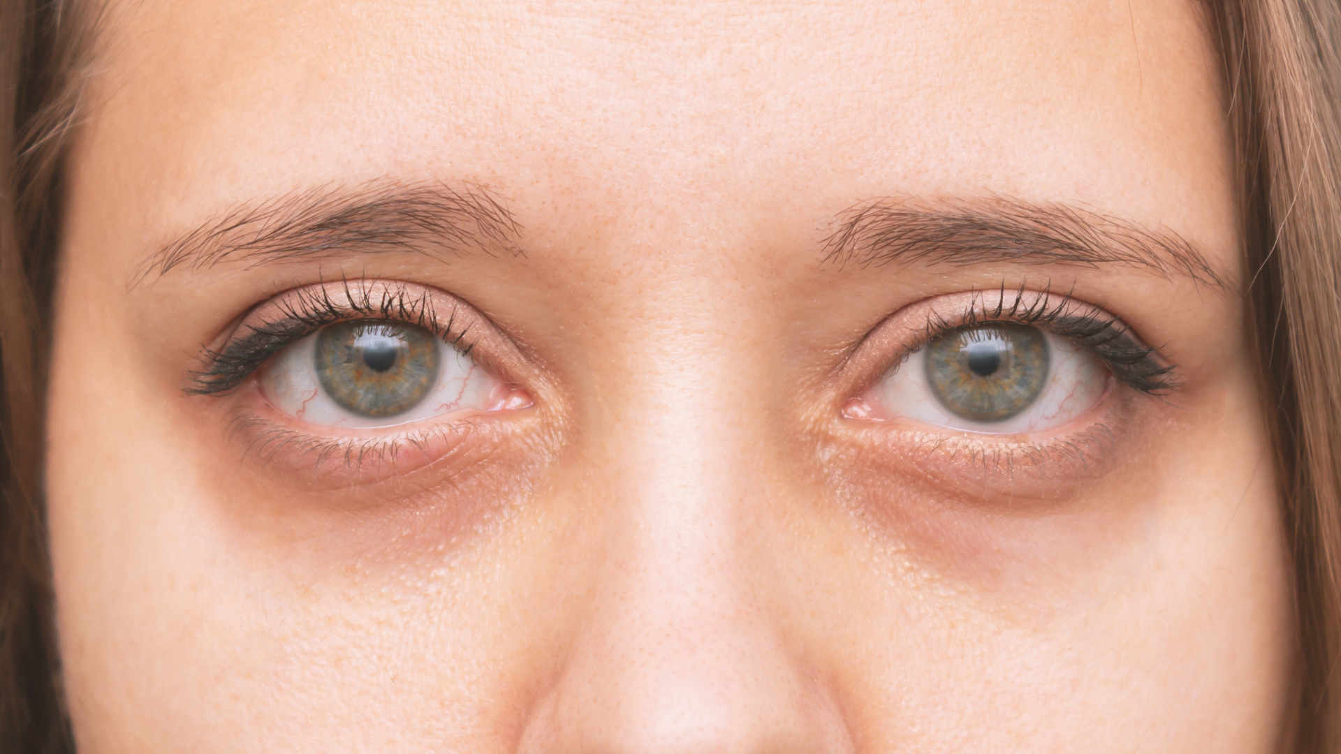 tratamento de olheiras