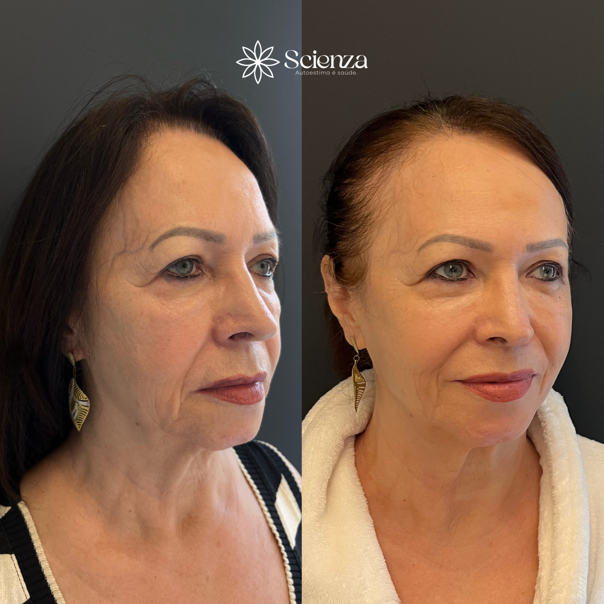 Card Bioestimulador de colágeno 1