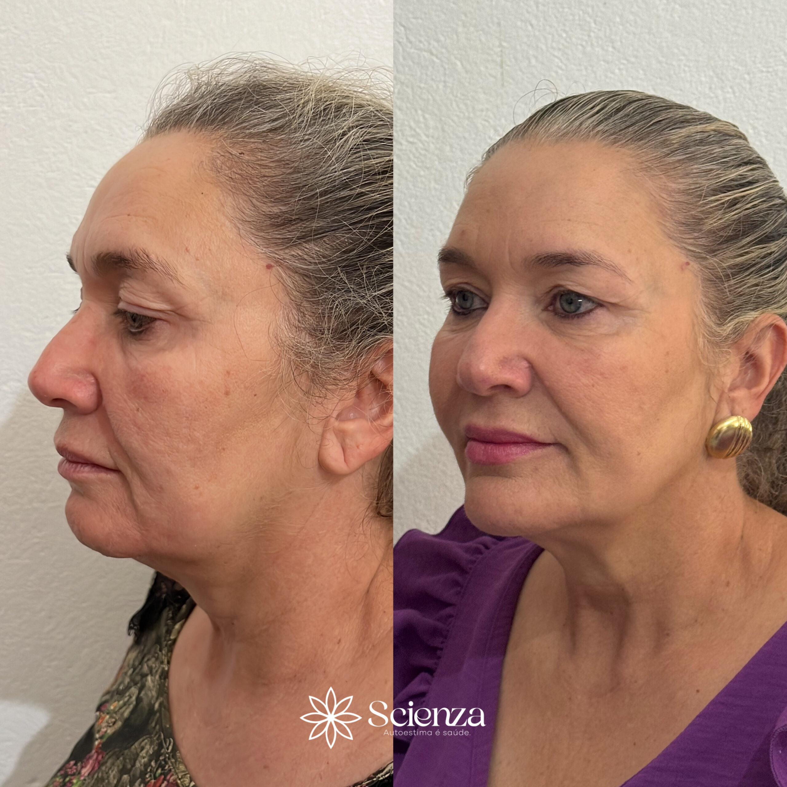 Card bioestimulador de colágeno 2 (1)