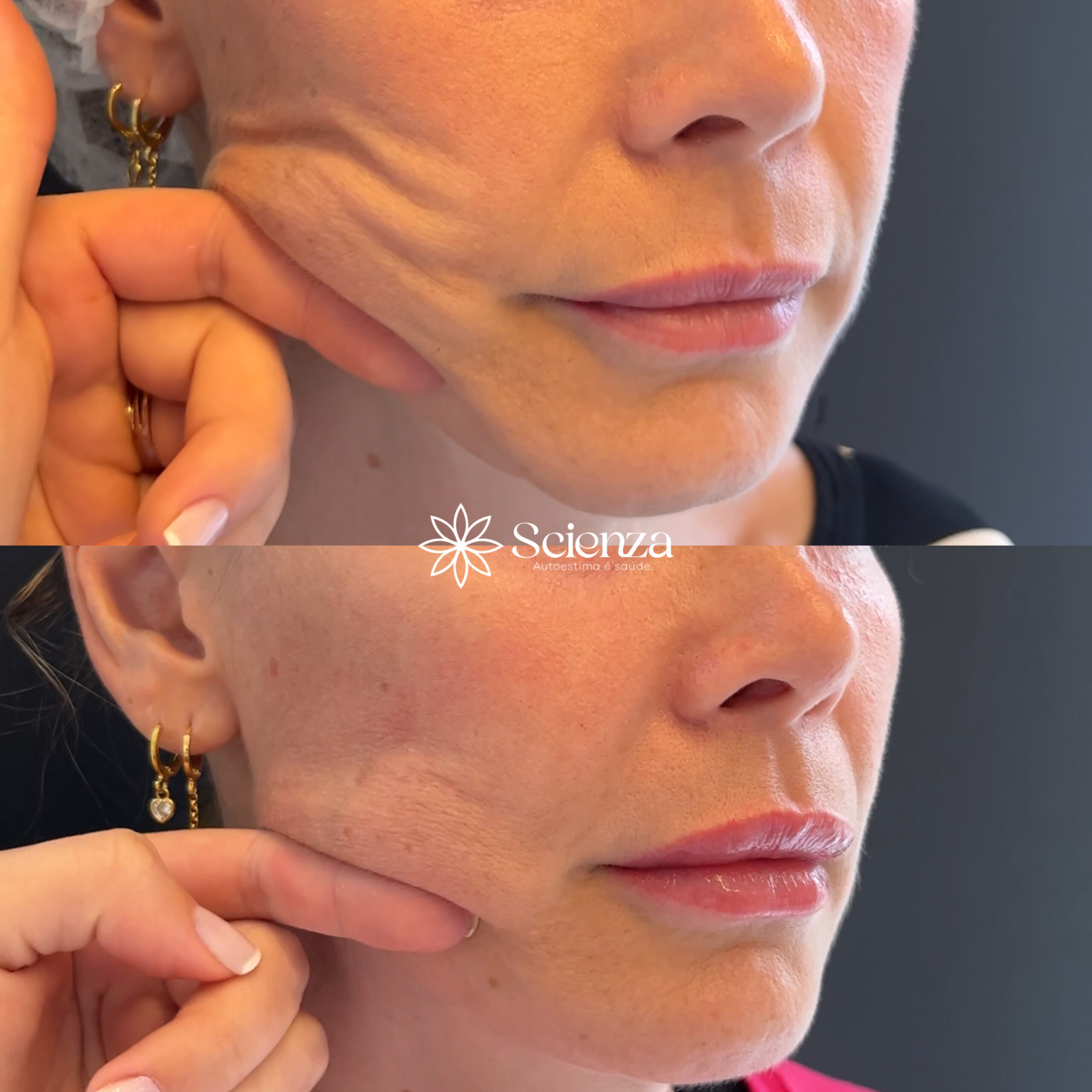 Card bioestimulador de colágeno