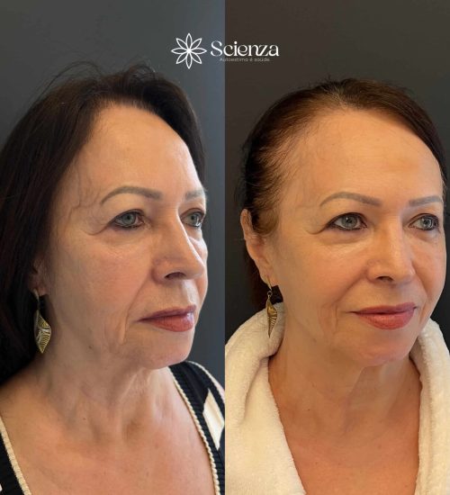 Card Bioestimulador de colágeno 1