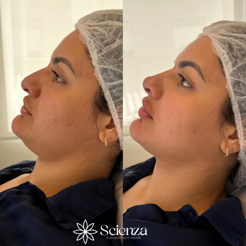 Card harmonização facial (1)