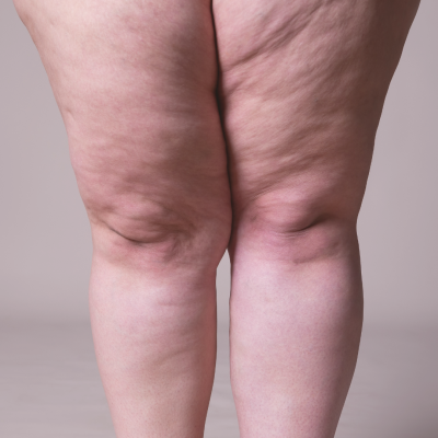 lipedema