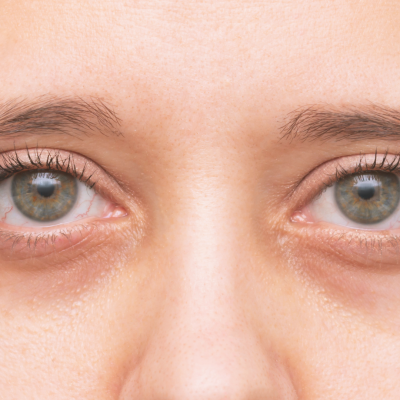 tratamento de olheiras