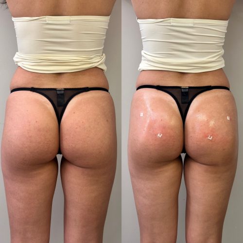 pág. harm. glútea - Antes e depois 2