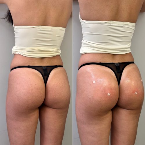 pág. harm. glútea - Antes e depois1